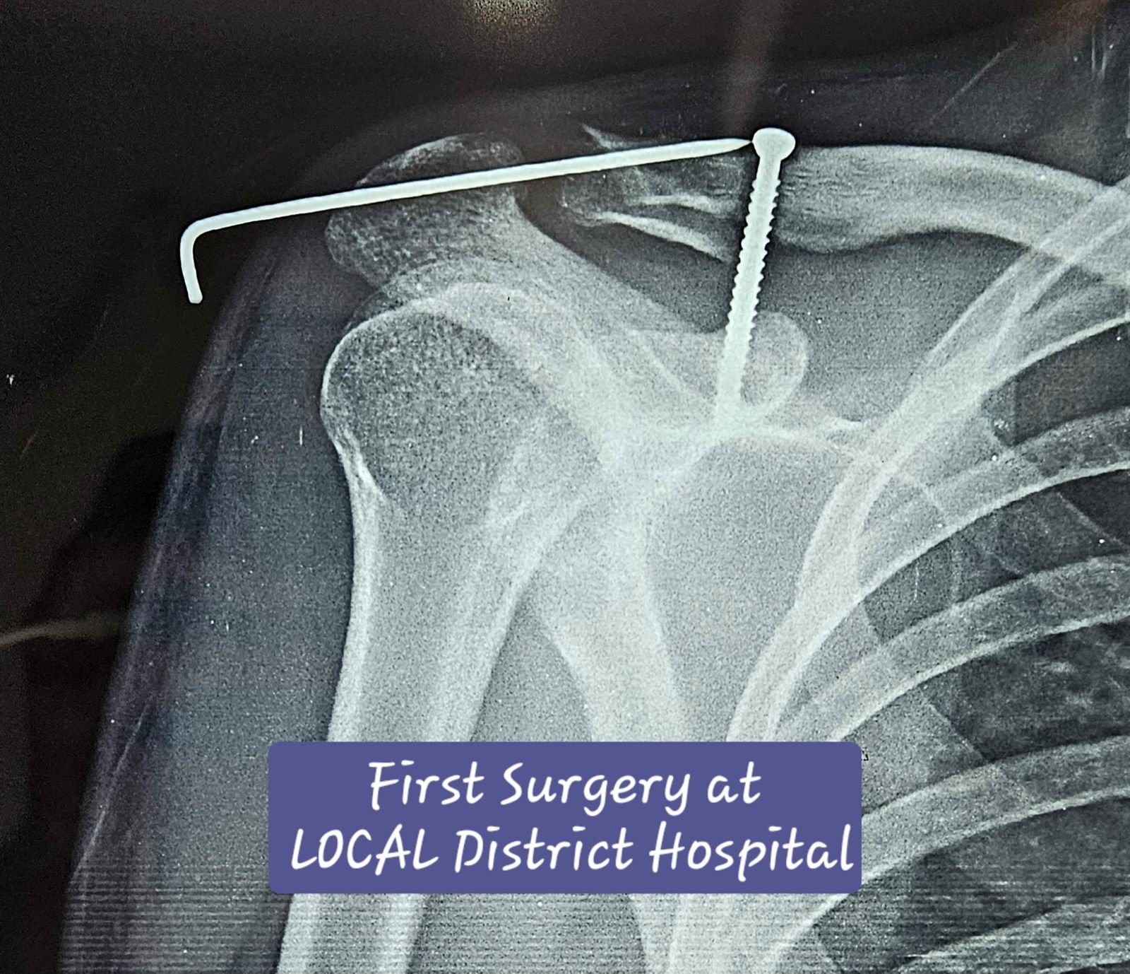Previous fixation X-ray of lateral end clavicle fracture non-union