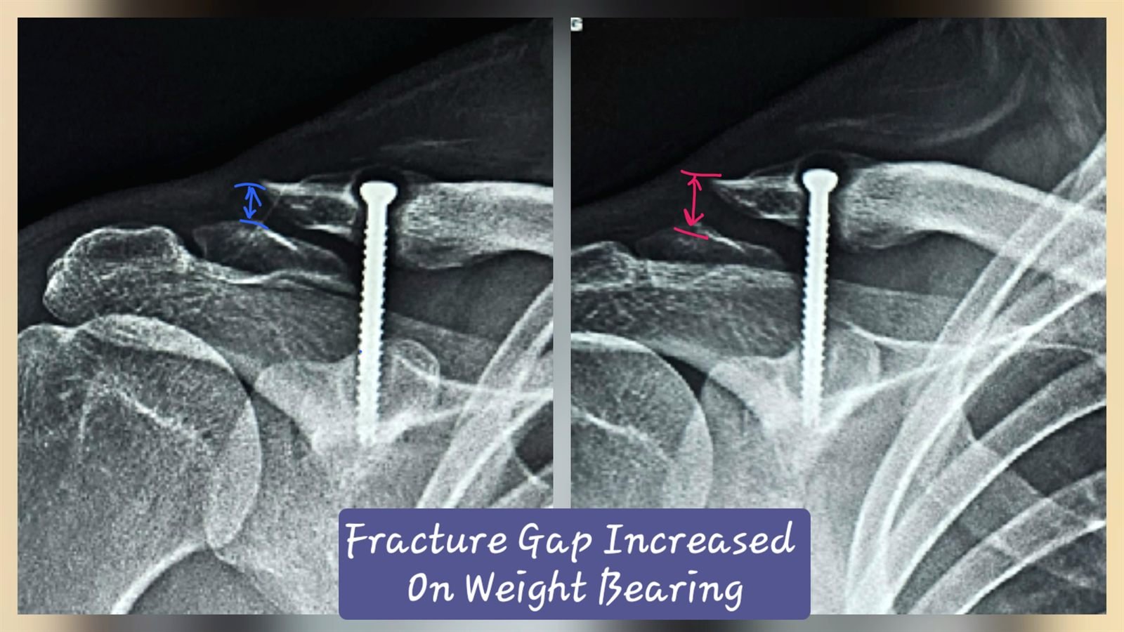 Weight-bearing X-ray showing increased fracture gap in lateral end clavicle non-union