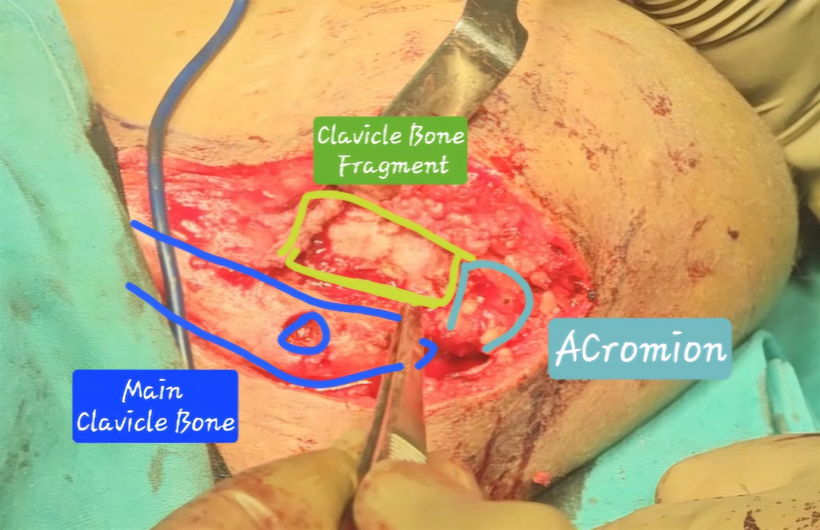 Intra-operative labelled view of lateral end clavicle fracture non-union