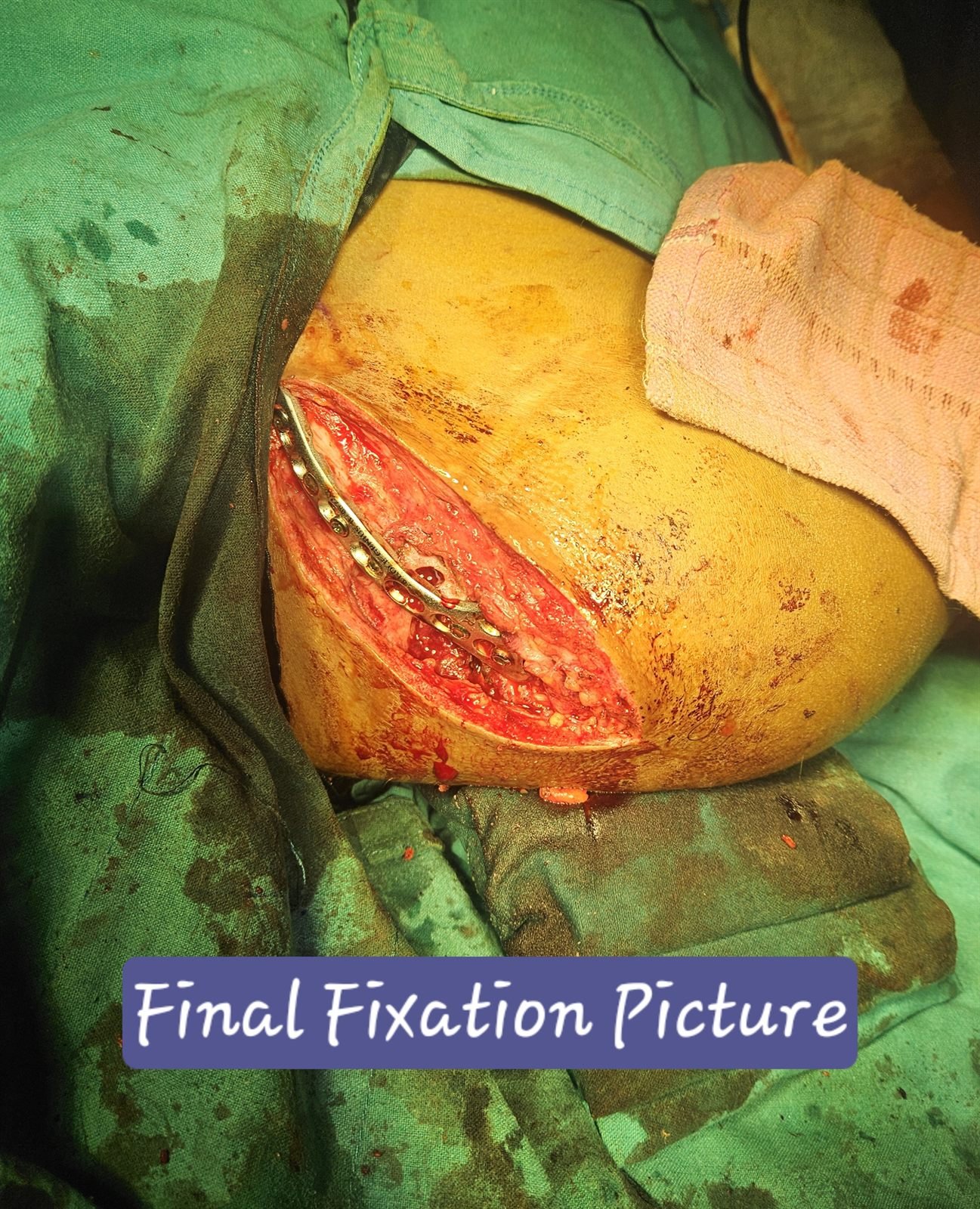 Final lateral clavicle fixation with plate during revision surgery