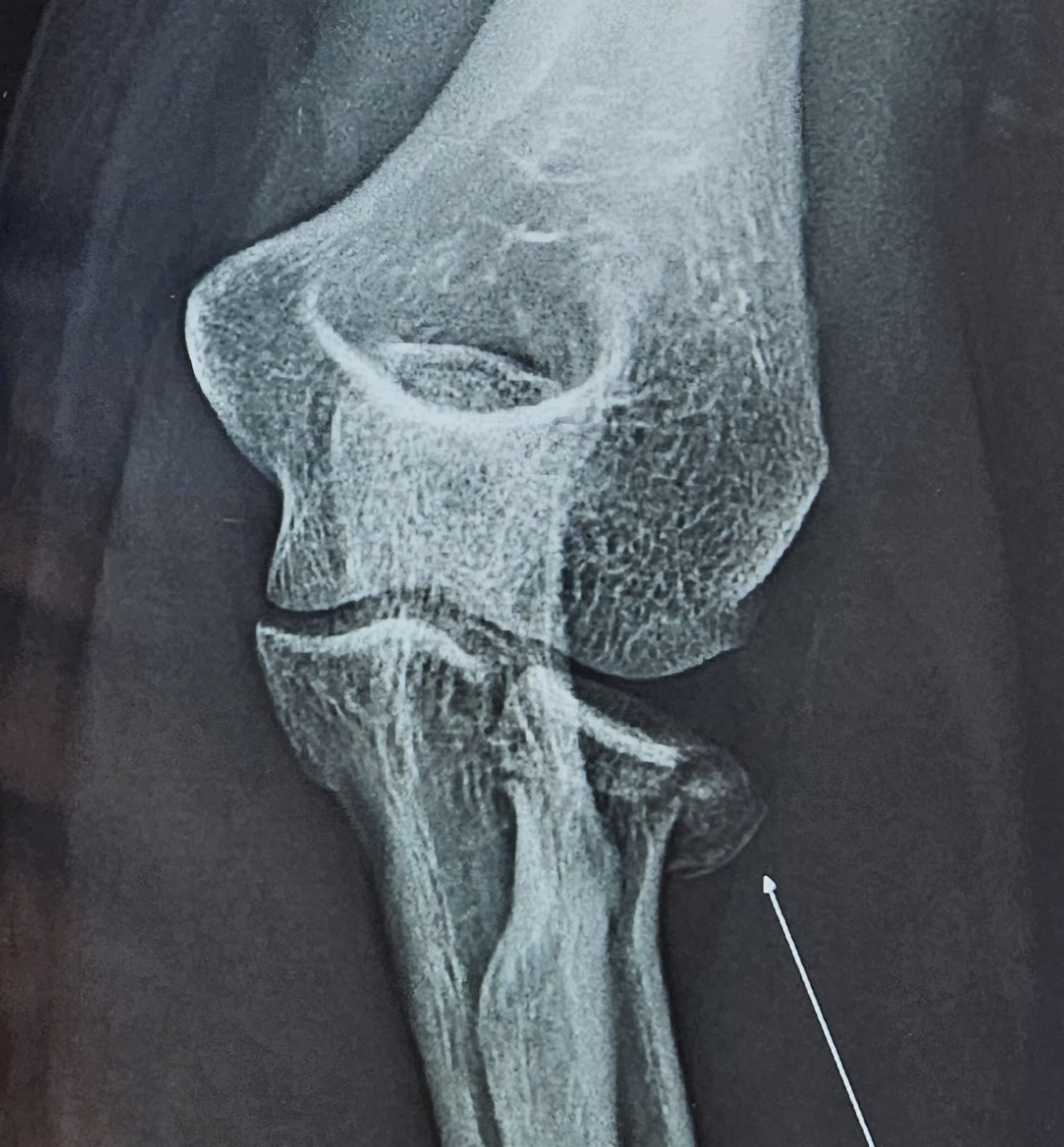 Pre-operative AP X-ray showing radial head fracture