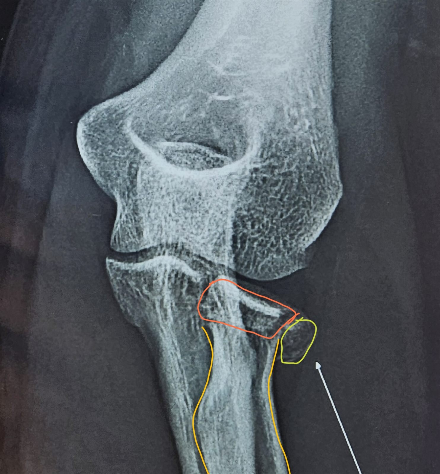 Annotated AP X-ray showing radial head fracture