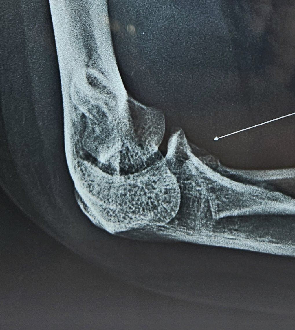 Lateral X-ray showing radial head fracture involvement
