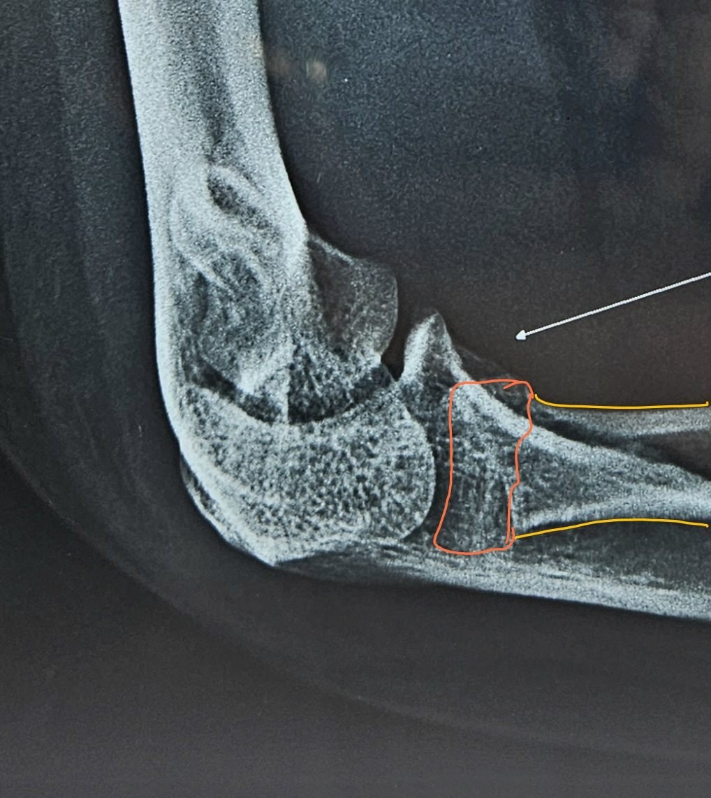 Annotated lateral X-ray showing radial head fracture