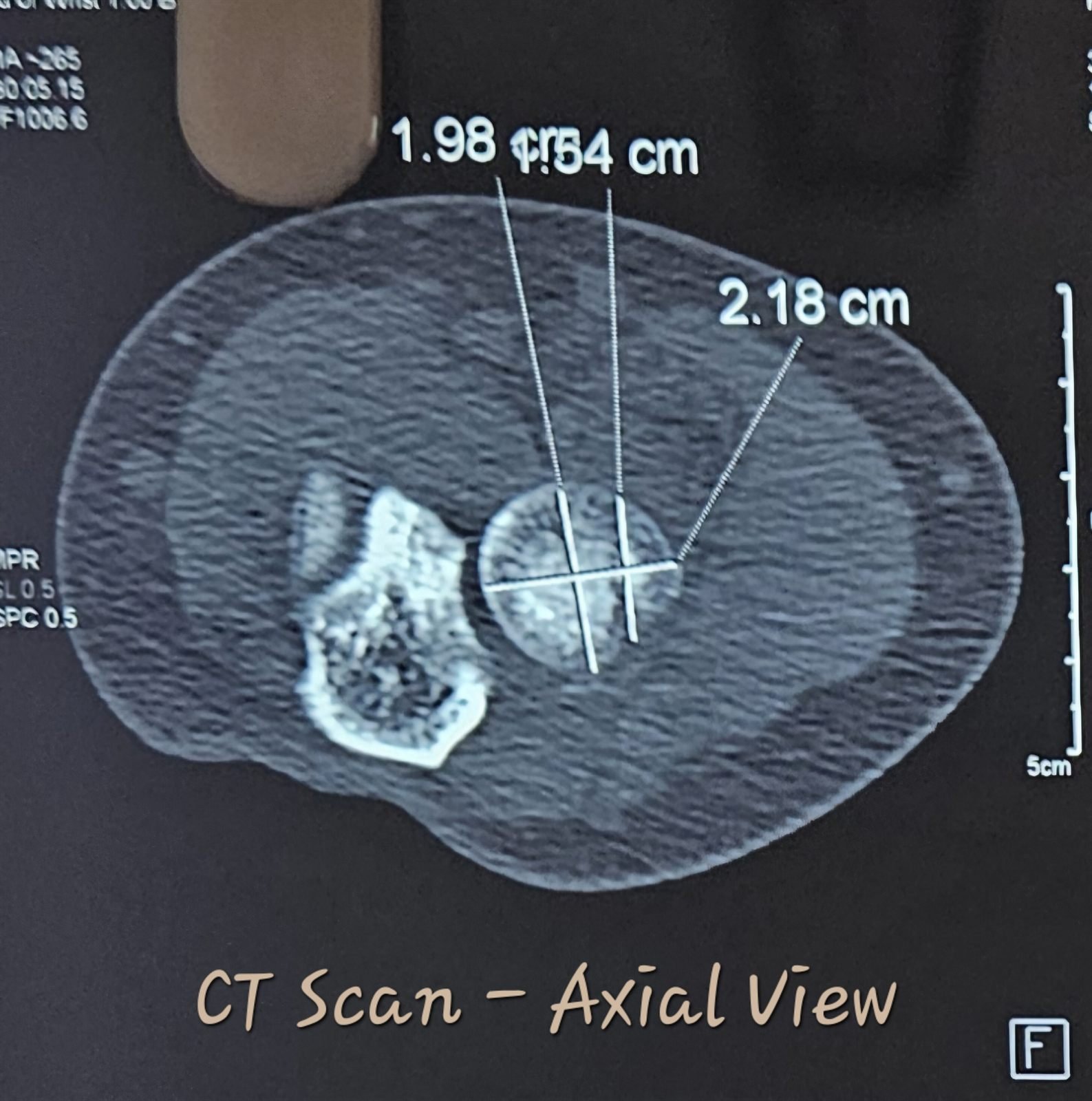 Axial CT showing radial head fracture fragment size