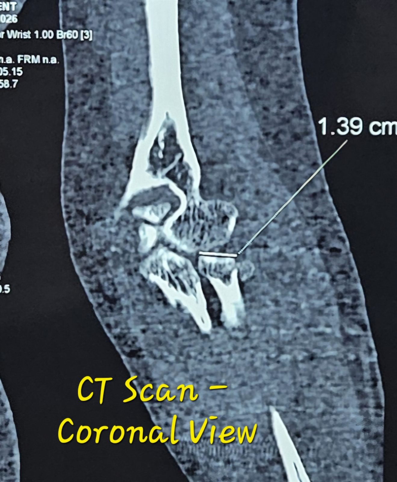 Coronal CT showing radial head fracture displacement
