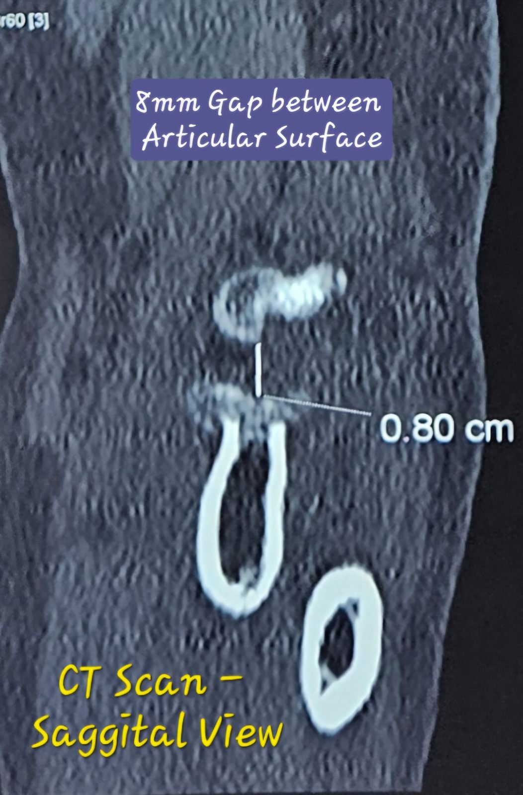 Sagittal CT showing radial head articular gap