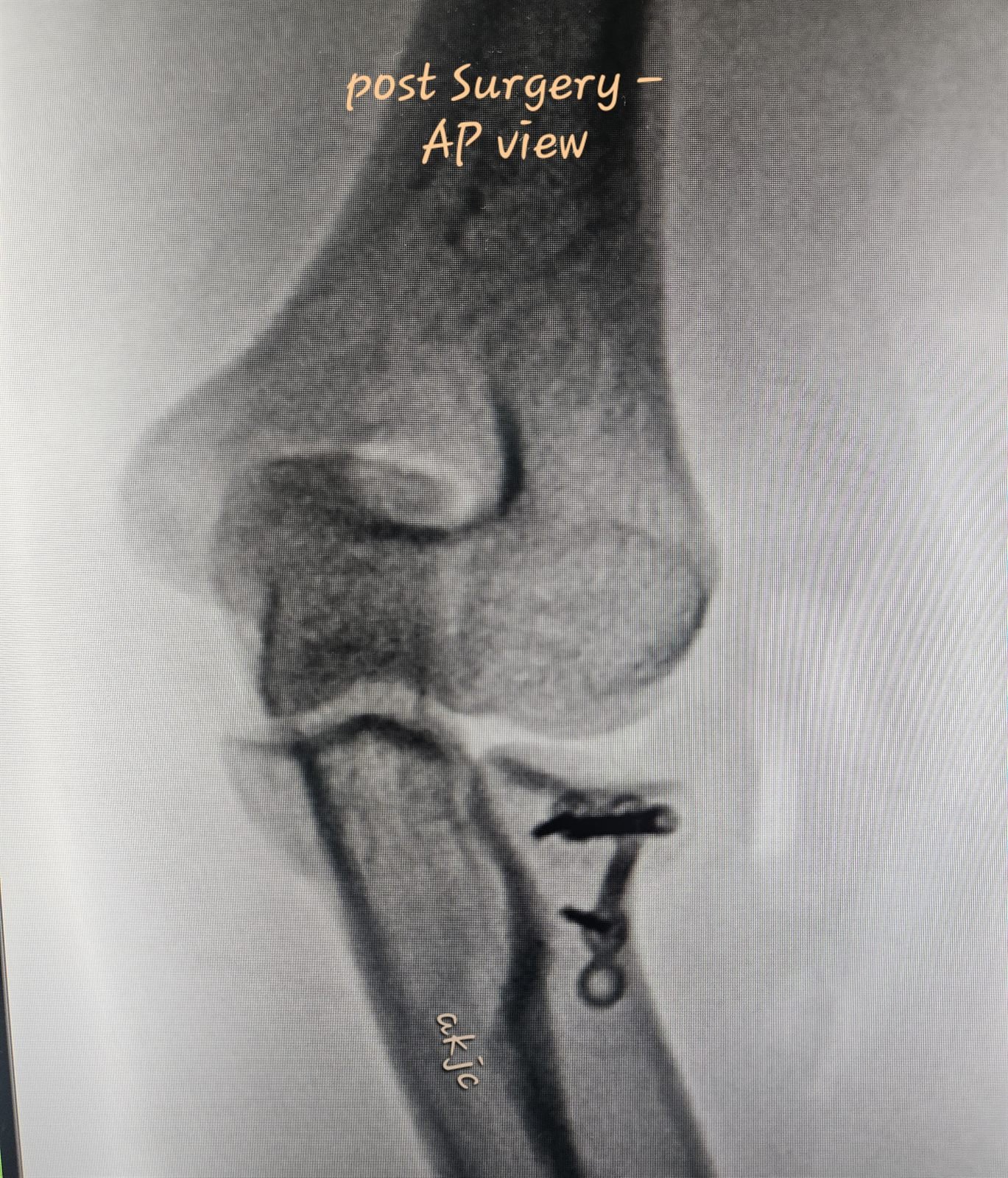 Post-operative AP X-ray after radial head reconstruction