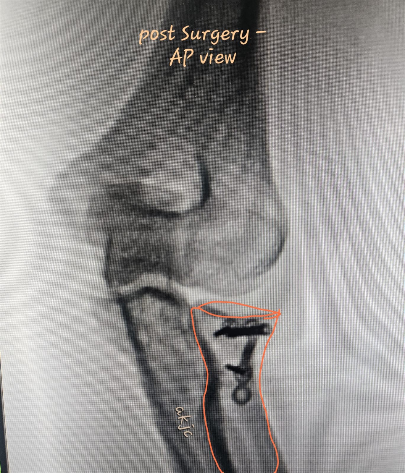Annotated post-operative AP X-ray after radial head reconstruction