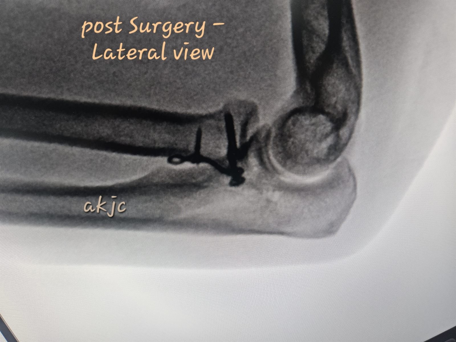 Post-operative lateral X-ray after radial head reconstruction