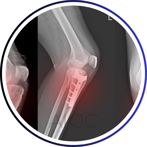 Fractures around Joints