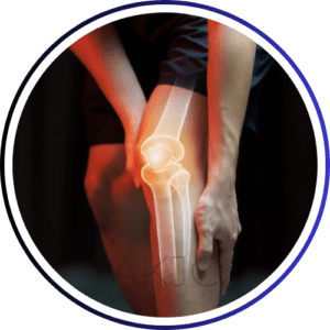 knee bone replacement