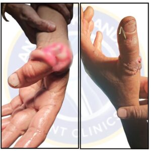 Injury of Thumb by Cutter / Grinder Machine