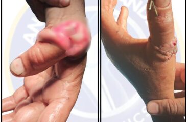 Injury of Thumb by Cutter / Grinder Machine