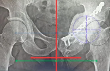 Hip Replacement in damaged