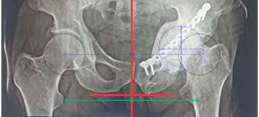 Hip Replacement in damaged