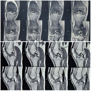 Anterior Cruciate Ligament of Knee Joint – Dr. Anupam Khandelwal