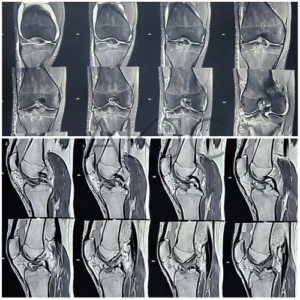 Anterior Cruciate Ligament of Knee Joint – Dr. Anupam Khandelwal