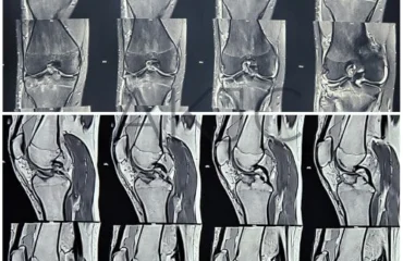 Anterior Cruciate Ligament of Knee Joint