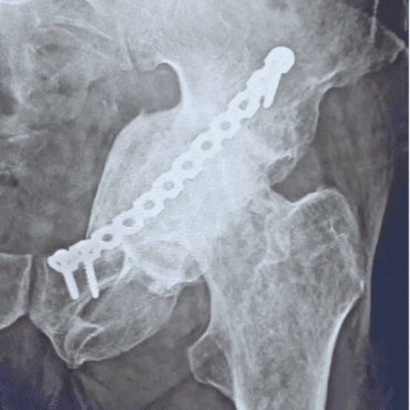 PROTUSIO ACETABULI SURGERY
