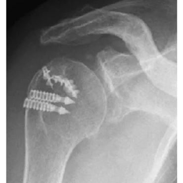 X-ray-imaging-after-arthroscopic-rotator-cuff-repair