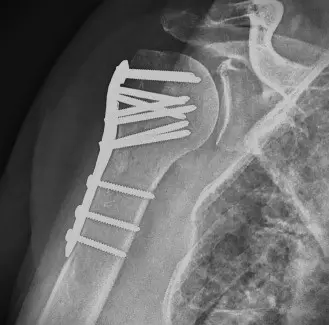 HUMERUS PLATING PROXIMAL