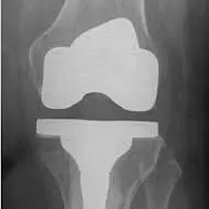 KNEE REPLACEMENT