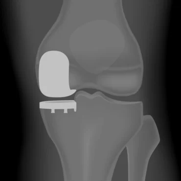 UNICOMPATMENTAL KNEE REPLACEMENT