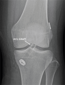 ACL RECONSTRUCTION SURGERY