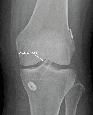 ACL RECONSTRUCTION SURGERY