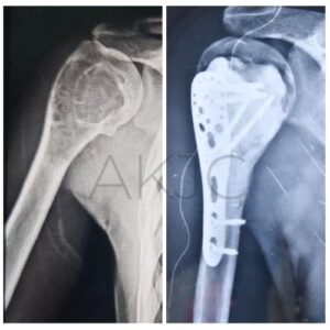 Treating a Giant Cell Tumor in the Shoulder: A Case Study from Dr. Anupam Khandelwal