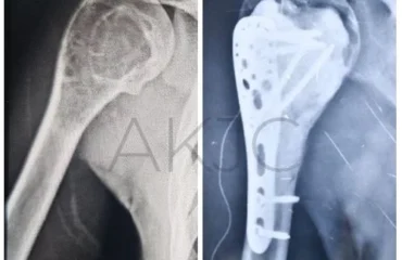 Treating a Giant Cell Tumor in the Shoulder A Case Study from Dr. Anupam Khandelwal