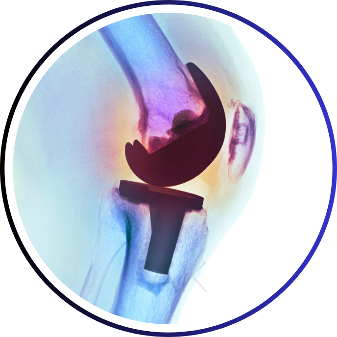 KNEE REPLACEMENT SURGERY