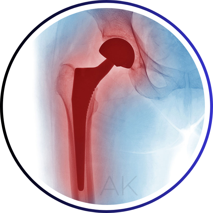 HIP REPLACEMENT SURGERY
