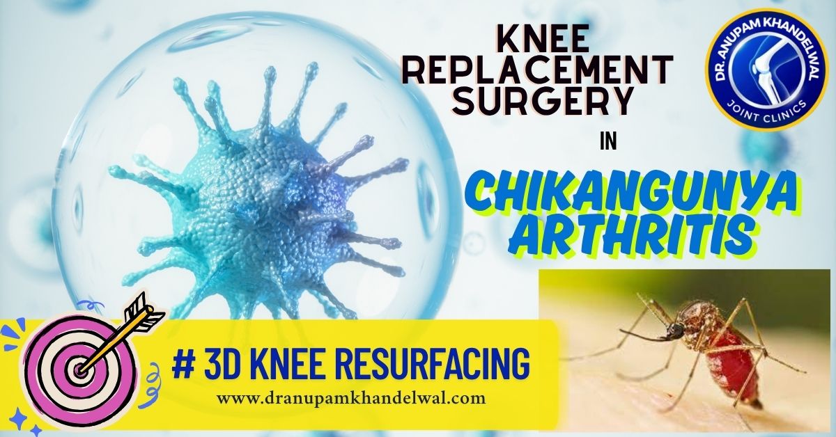 KNEE REPLACEMENT IN CHIKANGUNYA ARTHRITIS , INDORE, DR. ANUPAM KHANDELWAL,Best orthopedic surgeon ,best knee replacement indore, best hip replacement indore.