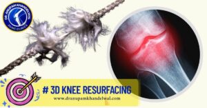 KNEE Osteoarthritis – Why Do Knees Get Worn Out ?