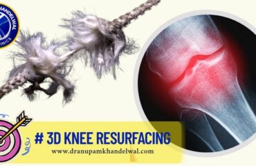 Knee Osteoarthritis - Wear & Tear of Knee JOint - Dr. Anupam Khandewal