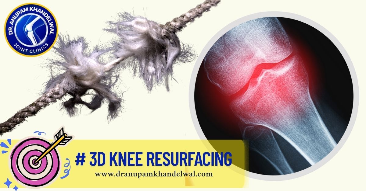 Knee Osteoarthritis - Wear & Tear of Knee JOint - Dr. Anupam Khandewal
