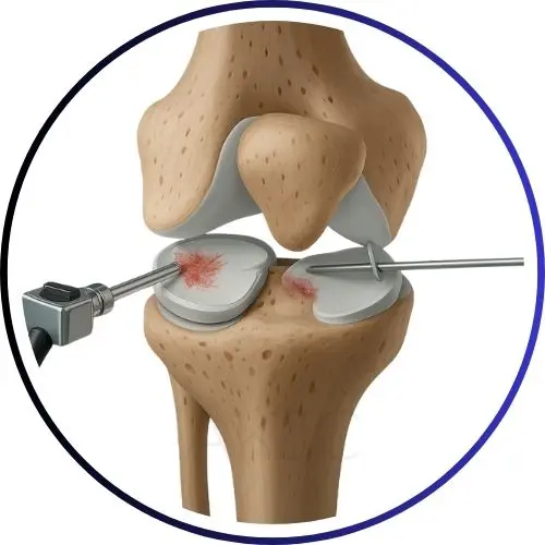 KNEE ARTHROSCOPY