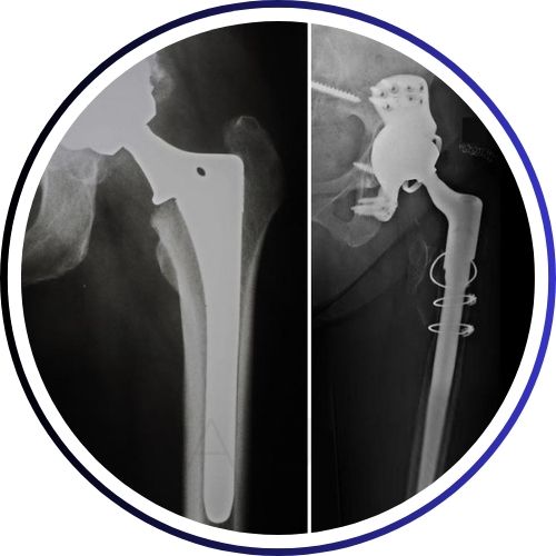 REVISION HIP REPLACEMENT SURGERY