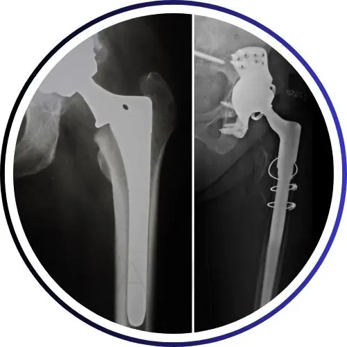 REVISION HIP REPLACEMENT SURGERY
