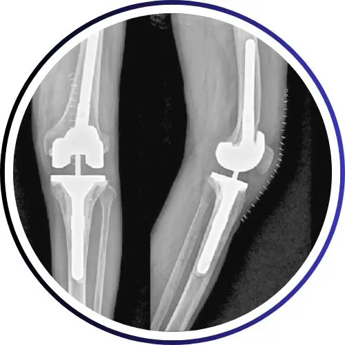 REVISION KNEE REPLACEMENT SURGERY