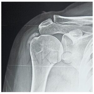 Treatment of Calcific Tendinitis of the Shoulder Joint – By Dr. Anupam Khandelwal