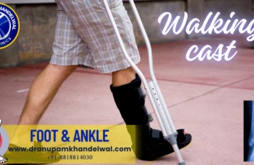 Dr. Anupam Khandelwal indore Walking cast for foot ankle injury / twisting / sprain.Best orthopedic surgeon ,best knee replacement indore, best hip replacement indore.