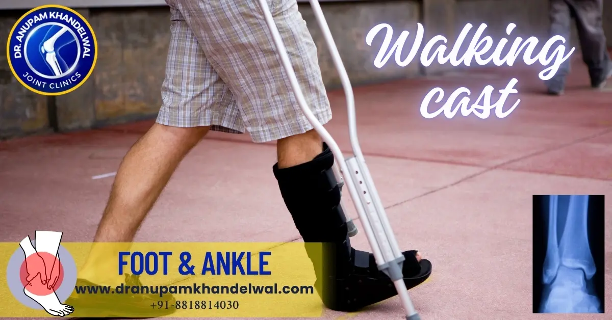 Dr. Anupam Khandelwal indore Walking cast for foot ankle injury / twisting / sprain.Best orthopedic surgeon ,best knee replacement indore, best hip replacement indore.