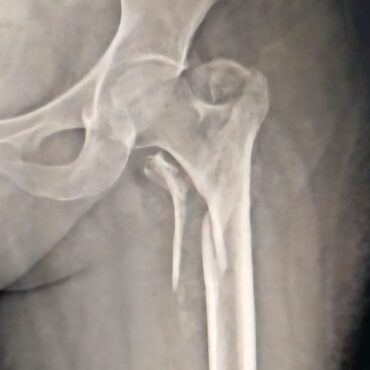 4 part hip fracture -communitted intertrochanteric fracture - Dr. Anupam Khandelwal