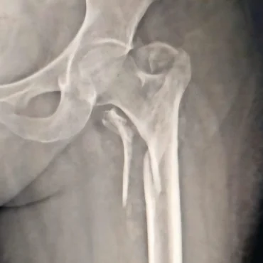 4 part hip fracture -communitted intertrochanteric fracture - Dr. Anupam Khandelwal