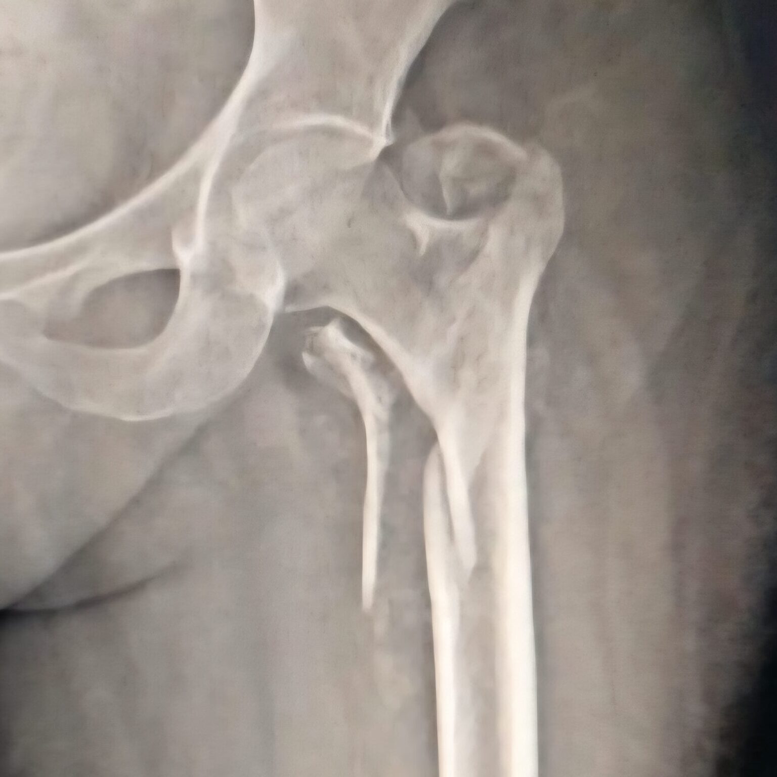 4 part hip fracture -communitted intertrochanteric fracture - Dr. Anupam Khandelwal