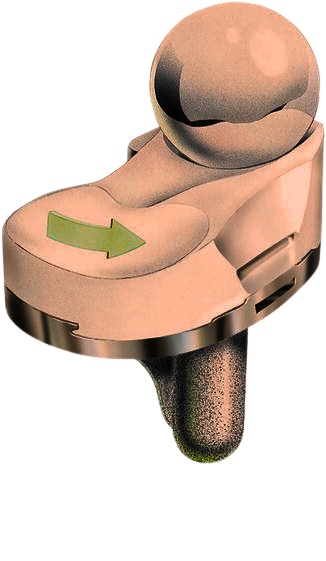 Medial pivot Knee - Dr. Anupam Khandelwal, indore
