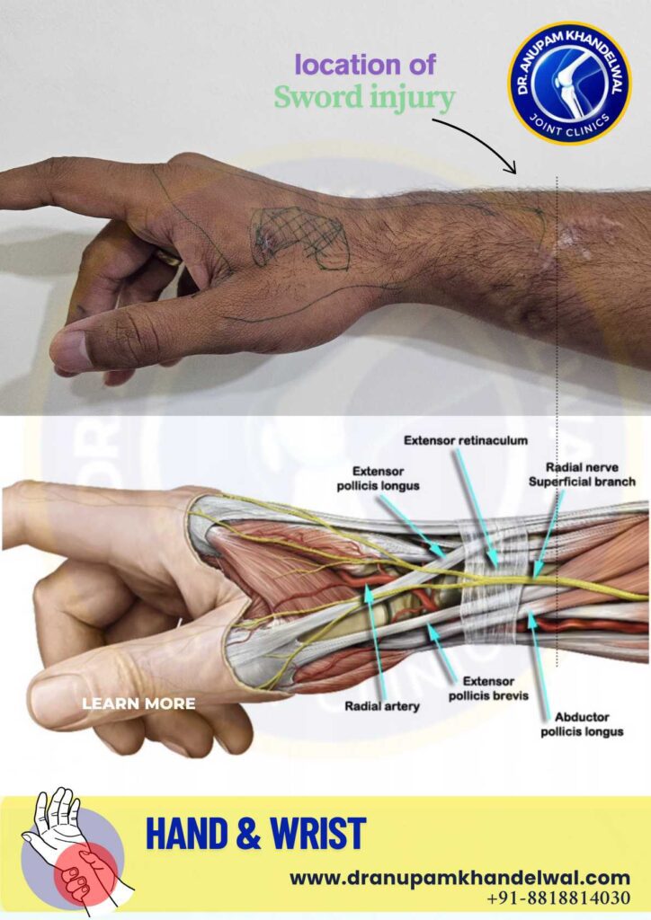 sword assault injury case -  sensory loss- Superficial radial nerve damage - DR. Anupam Khandelwal, Indore